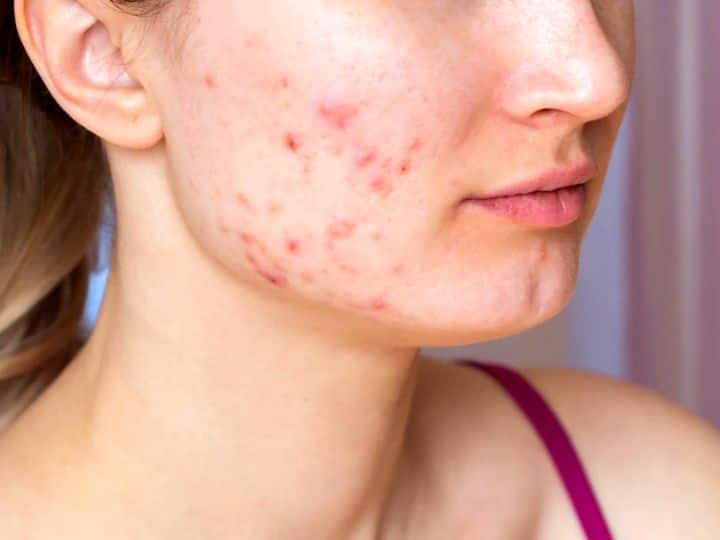 How To Get Rid Of Pimple Acne From Skin Change These Sleeping Mistakes Pimples: सोते वक्त भूलकर भी न करें ये 5 गलतियां, वरना पिंपल्स नहीं छोड़ेंगे पीछा