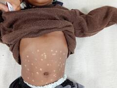 शहडोल में तीन महीने की बच्ची को लोहे की सलाखों से 24 बार दागा, ढाई माह की बच्ची की हो चुकी है मौत