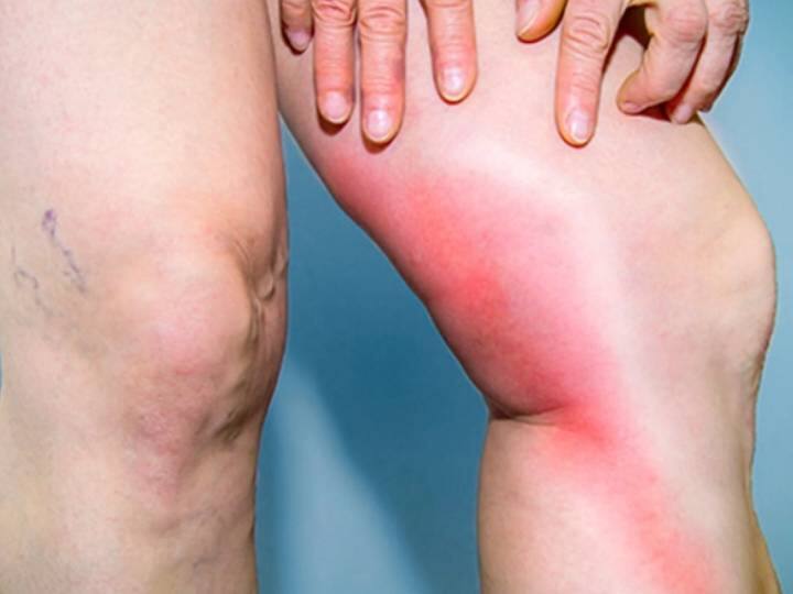 Bone Cancer Types Causes Symptoms and More Bone Cancer: पैरों में होने वाला नॉर्मल दर्द हो सकता है बोन कैंसर, आप ऐसे कर सकते हैं पहचान