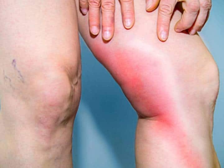 Bone Cancer: पैरों में होने वाला नॉर्मल दर्द हो सकता है बोन कैंसर, आप ऐसे कर सकते हैं पहचान Bone Cancer Types Causes Symptoms and More Bone Cancer: पैरों में होने वाला नॉर्मल दर्द हो सकता है बोन कैंसर, आप ऐसे कर सकते हैं पहचान