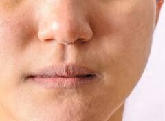 ਕੋਈ ਮਹਿੰਗਾ ਇਲਾਜ ਨਹੀਂ... ਸਕਿਨ ਦੀ ਇਹ ਸਮੱਸਿਆ ਸਿਰਫ ਹਲਦੀ ਲਾਉਣ ਨਾਲ ਹੋ ਸਕਦੀ ਠੀਕ, ਤੁਸੀਂ ਵੀ ਕਰੋ ਟ੍ਰਾਈ