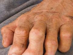 राष्ट्रपिता महात्मा गांधी की डेथ एनिवर्सरी पर ही क्यों मनाया जाता है विश्व कुष्ठ दिवस...जानिए इसके बारे में सबकुछ