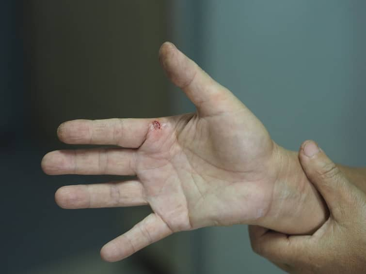 Doctors reattach three amputated fingers