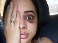 उर्फी जावेद के चेहरे का हुआ ऐसा हाल, फोटो शेयर कर बोलीं- ‘ऐसा लग रहा किसी ने मारा है...’