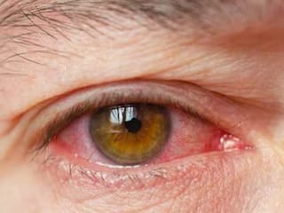 Health Tips : लॅपटॉप आणि मोबाईलच्या अतिवापरामुळे डोळे कोरडे होतायत? 'या' घरगुती उपायांनी मिळवा आराम
