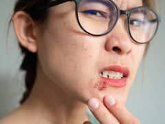 क्यों होठ के पास बार-बार हो जाती है ये हर्पीज... जान लीजिए ये क्यों होता है और इसका इलाज क्या है?