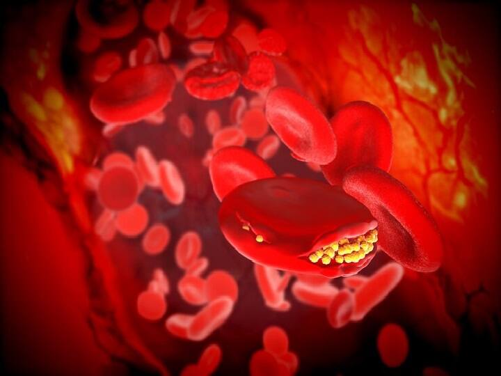 High Cholesterol From yellow spots near the eyes to nails this problem can be a sign of high cholesterol High cholesterol: आंखों के पास पीले धब्बों से लेकर नाखूनों में ये समस्या हो सकती है हाई कोलेस्ट्रॉल का संकेत, नजरअंदाज न करें