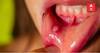 ਜੇਕਰ ਤੁਹਾਡੇ ਮੁੂੰਹ 'ਚ ਵੀ ਨਜ਼ਰ ਆਉਂਦੇ ਇਹ ਲੱਛਣ, ਤਾਂ ਤੁਹਾਨੂੰ ਹੋ ਸਕਦਾ ਇਹ ਕੈਂਸਰ, ਜਾਣੋ ਇਸ ਬਾਰੇ