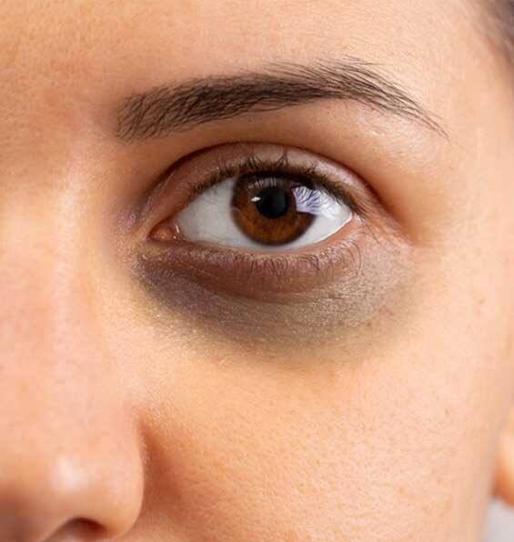 তবে বেশ কিছু খাবারের মাধ্যমে ডার্ক সার্কেল কমানো সম্ভব। বিশেষজ্ঞরা বলছেন, ভিটামিন C, A, B, এবং E সমৃদ্ধ খাওয়া যেতে পারে।