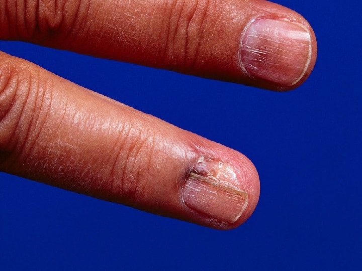 World Cancer Day Never ignore this one sign on your nail World Cancer Day 2023: नाखूनों के अंदर भी पनप सकता है कैंसर, इन संकेत को समय रहते पहचानना है जरूरी