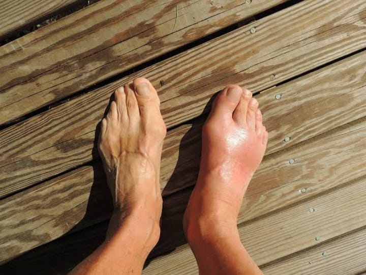 Health Tips Swollen Legs Feet Ankle Symptom Cause Remedy Cure Edema Kidney Disease