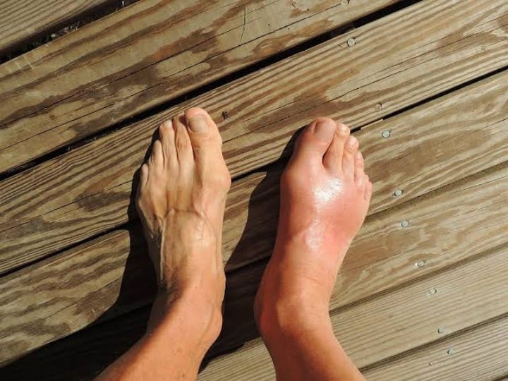 health tips swollen legs feet ankle symptom cause remedy cure edema kidney disease Swollen Legs: हल्के में न लें घुटनों से पैर के तलवे तक सूजन और दर्द, खतरनाक बीमारी की चपेट में आ सकते हैं आप