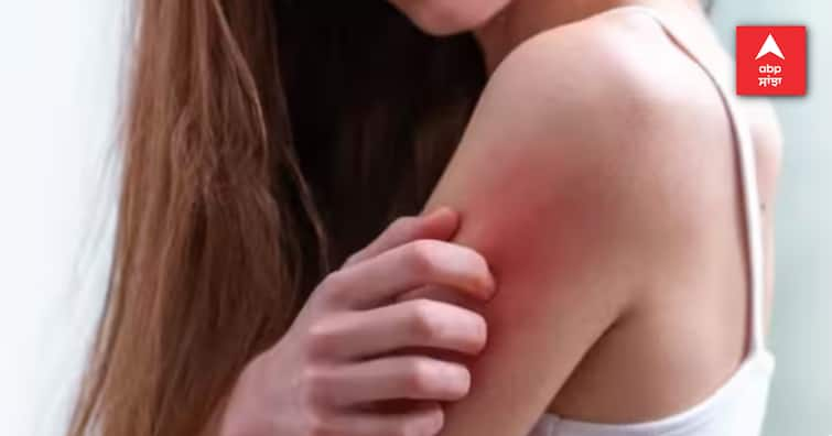 people-with-light-skin-colour-have-higher-skin-cancer-risk Skin Cancer: ਗੋਰੇ ਲੋਕਾਂ ਨੂੰ ਸਕਿਨ ਕੈਂਸਰ ਦਾ ਵੱਧ ਖਤਰਾ, ਜਾਣੋ ਕਿਵੇਂ ਕਰ ਸਕਦੇ ਹੋ ਬਚਾਅ