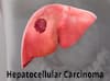 கல்லீரல் புற்றுநோய்: ஹெப்டோசெல்லுலர் கார்சினோமாவின் பின்னணியில் உள்ள அபாயங்கள் என்னென்ன?