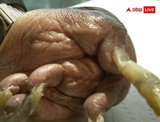 66 ਸਾਲਾਂ ਵਿਚ ਲੰਬਾਈ ਦੇ ਨਾਲ-ਨਾਲ ਨਹੁੰਆਂ ਦੀ ਮੋਟਾਈ ਵੀ ਬਹੁਤ ਵੱਧ ਗਈ ਸੀ, ਸ੍ਰੀਧਰ ਦੇ ਨਹੁੰ ਕੱਟਣ ਲਈ ਲੋਹੇ ਕੱਟਣ ਵਾਲੀ ਮਸ਼ੀਨ ਦੀ ਵਰਤੋਂ ਕੀਤੀ ਗਈ ਸੀ।