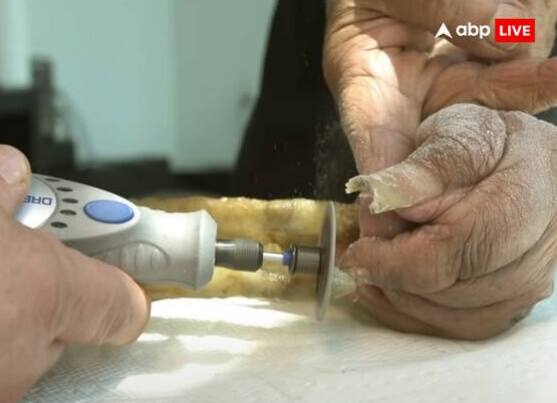 ਨਹੁੰ ਵੱਧਣ ਕਾਰਨ ਉਨ੍ਹਾਂ ਨੂੰ ਕਈ ਸਮੱਸਿਆਵਾਂ ਦਾ ਸਾਹਮਣਾ ਕਰਨਾ ਪੈਂਦਾ ਸੀ, ਜਿਵੇਂ ਕਿ ਨਹੁੰਆਂ ਦੇ ਭਾਰ ਕਾਰਨ ਉਨ੍ਹਾਂ ਦਾ ਖੱਬਾ ਹੱਥ ਕੰਮ ਕਰਨਾ ਬੰਦ ਕਰ ਦਿੰਦਾ ਸੀ, ਖੱਬਾ ਕੰਨ ਵੀ ਬੋਲ਼ਾ ਹੋ ਜਾਂਦਾ ਸੀ, ਉਨ੍ਹਾਂ ਨੂੰ ਆਪਣੇ ਨਿੱਜੀ ਕੰਮ ਕਰਨ ਵਿੱਚ ਵੀ ਮੁਸ਼ਕਲਾਂ ਦਾ ਸਾਹਮਣਾ ਕਰਨਾ ਪੈਂਦਾ ਸੀ।