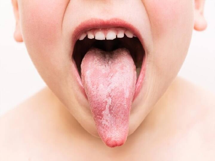 tongue may warn of vitamin BTwelve and BNine deficiencies Vitamin Deficiencies: शरीर में इस विटामिन की कमी होने पर जीभ देती है ये संकेत, इन लक्षण को ना करें इग्नोर