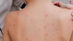 WB Chicken Pox: চিকেন পক্সে ফেব্রুয়ারিতে একের পর এক মৃত্যু রাজ্যে