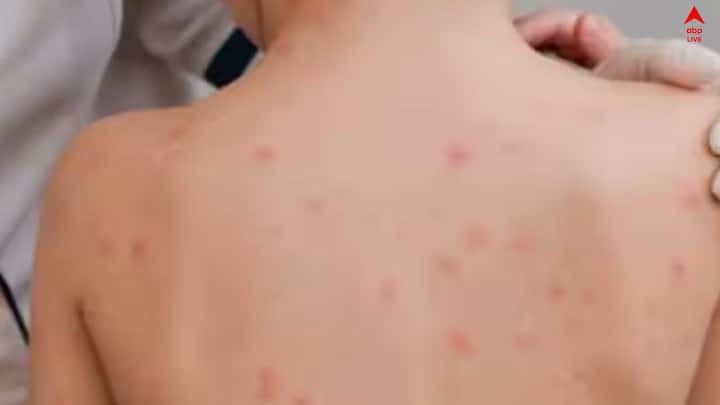 চিকেন পক্সে বাড়তে থাকা মৃত্যু দেখে সতর্ক থাকতে বলছেন চিকিৎসকরা। 