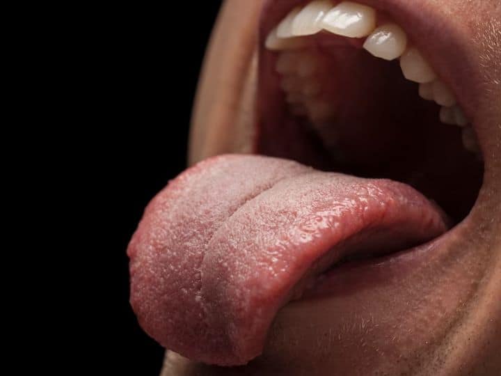 Dry Mouth Called Xerostomia Causes Symptoms Treatment क्या मुंह जरूरत से ज्यादा सूखा रहता है? नहीं बनता सलाइवा? कहीं आपको ये बीमारी तो नहीं!