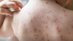 WB Chicken Pox: চিকেন পক্সে ফেব্রুয়ারিতে একের পর এক মৃত্যু রাজ্যে