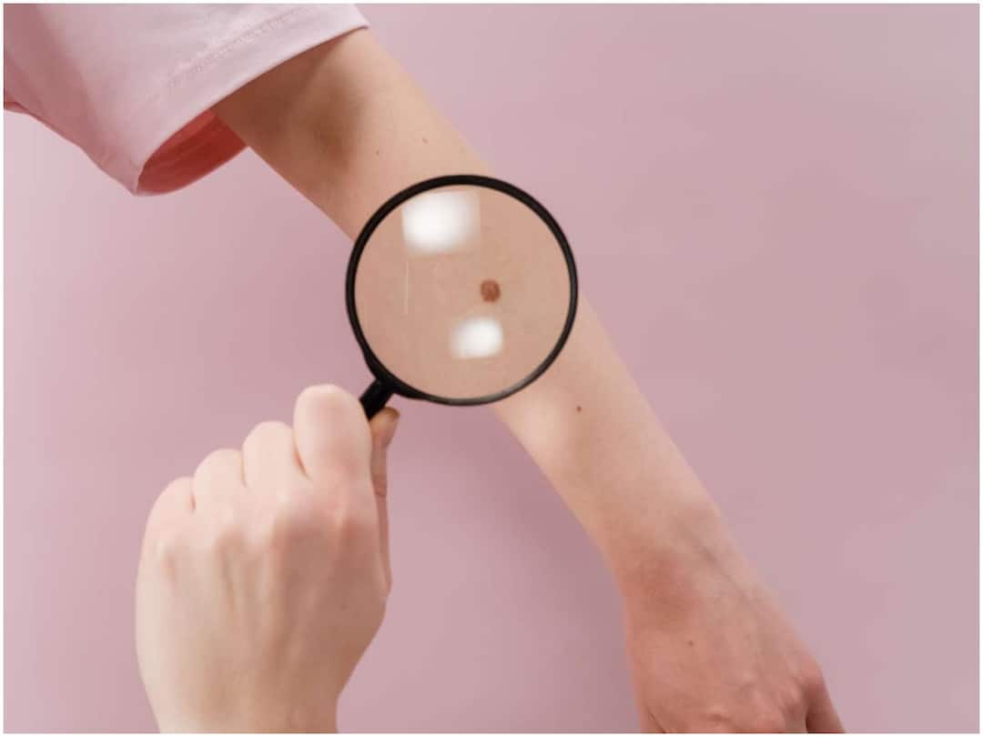 A cancer cell hurts a lot, unfortunately she has 20 cancer tumors in her body ఒక క్యాన్సర్ కణితే ఎంతో బాధిస్తుంది, పాపం ఈమెకు శరీరంలో 20 క్యాన్సర్ కణితులు