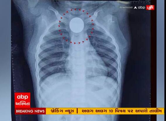 Surat: રમત રમતમાં બાળક ગળી ગયો રૂપિયાનો સિક્કો, ડોક્ટર્સે ભારે જહેમત કાઢ્યો સિક્કો બહાર