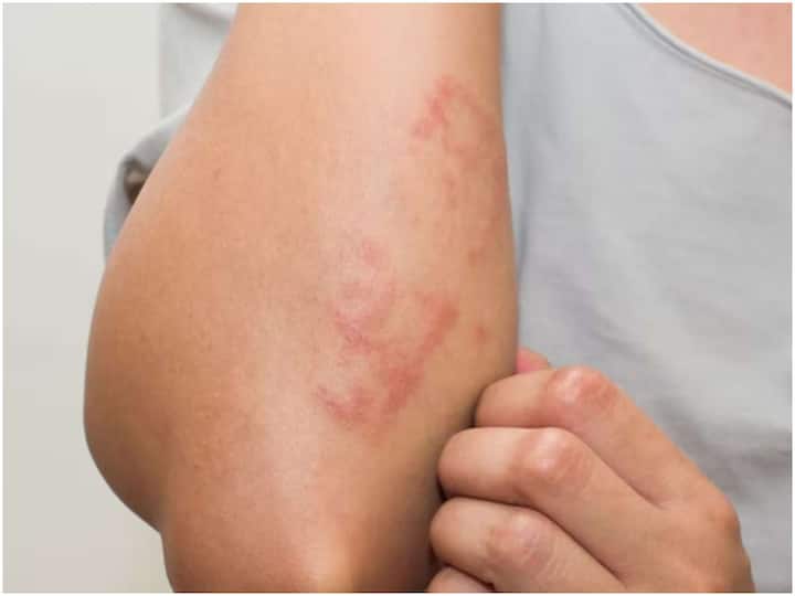 These are the causes of red rashes and itching on the body శరీరంపై ఎర్రటి దద్దుర్లు, దురదకు కారణాలు ఇవే, ఒక్కోసారి తగ్గడం కష్టమే