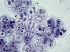 Flesh-Eating Bacteria: 11-Year-Old US Boy Dies After Twisting Ankle On Treadmill