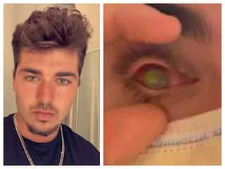 Man sleep with contact lens parasites eat his eyes shocking incident in america Contact Lens : உஷார் மக்களே..கான்டாக்ட் லென்ஸ் உடன் தூங்கியதால் வந்த வினை.. பார்வைபோன பயங்கரம்..