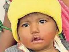 एक साल की बच्ची की सांस नली में फंसा घड़ी का लॉक, एक्स-रे कराया तब हुआ खुलासा, फिर जो हुआ...