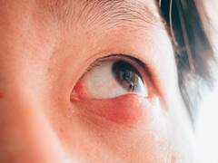 What Is A Stye- Know Ways To Treat It