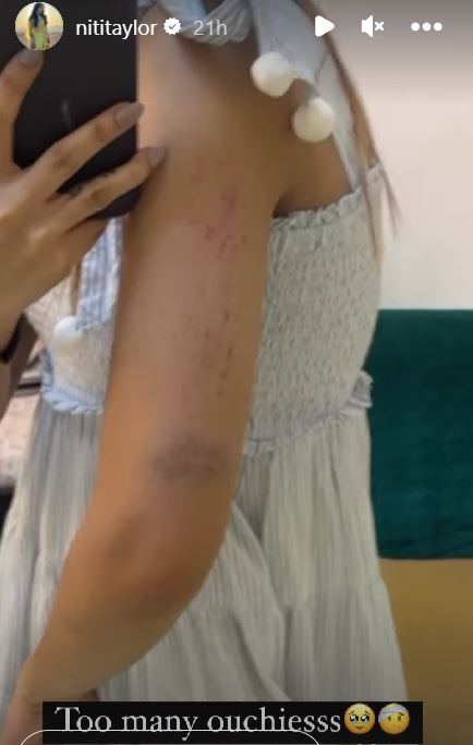 Niti Taylor Injured: ‘बड़े अच्छे लगते हैं’ के सेट पर घायल हुईं नीति टेलर, दिखाए अपने चोट के निशान