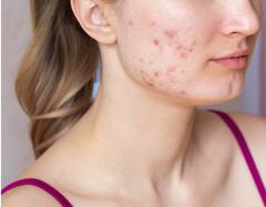 Patchouli Oil: सेलेब्स का ब्यूटी सीक्रेट है ये आयुर्वेदिक तेल, जानिए इसके अमेजिंग फायदे