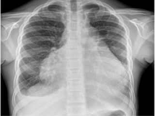 Health News : पेरिकार्डियल इफ्यूजन म्हणजे काय?; लक्षणे, कारणे आणि उपचार