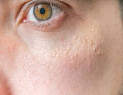 चेहरे पर सफेद दानों ने बिगाड़ दिया है हुलिया, इस तरह पा सकते हैं छुटकारा