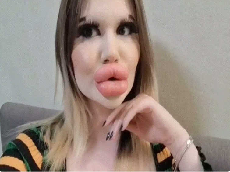 Woman With The Worlds Biggest Lips Now Wants Huge Cheekbones