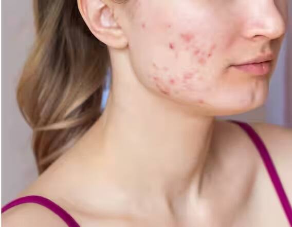 Patchouli oil: This Ayurvedic oil is the beauty secret of celebs, know its amazing benefits Patchouli oil: This Ayurvedic oil is the beauty secret of celebs, know its amazing benefits