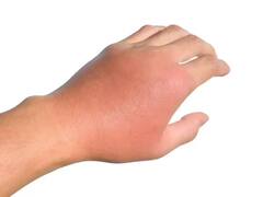 आग से जलने पर तुरंत अपना लें ये 7 घरेलू नुस्खे...दवाई से भी जल्दी कर सकता है असर