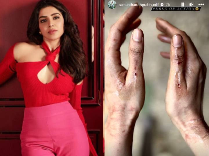 Actress Samantha Ruth Prabhu gets bruises while filming action sequences Actress Samantha: என்னது...? சமந்தாவுக்கு காயமா? சிட்டாடல் படப்பிடிப்பில் பரபரப்பு - வெளியான புகைப்படம்: ரசிகர்கள் அதிர்ச்சி