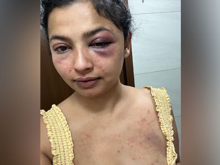 Anicka Vikhraman की एक्स बॉयफ्रेंड ने की बेरहमी से पिटाई, शॉकिंग फोटो शेयर कर एक्ट्रेस ने सुनाई आपबीती