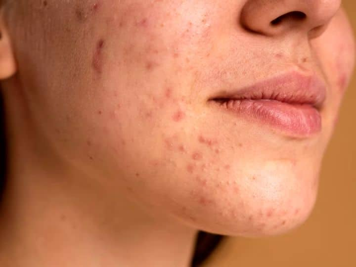 Dark Spots On Face Know Causes And How To Remove Them With Home Remedies चेहरे पर काले धब्बे! जानिए किन कारणों से होते हैं 'डार्क स्पॉट्स'...और कैसे पाया जाए छुटकारा?