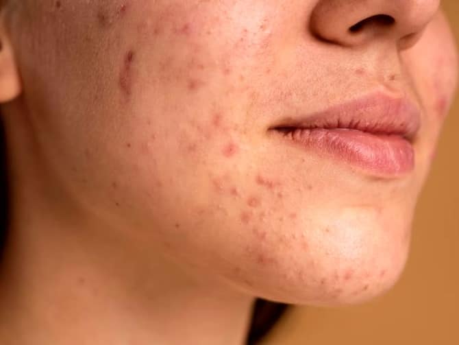 Dark Spots On Face Know Causes And How To Remove Them With Home Remedies |  चेहरे पर काले धब्बे! जानिए किन कारणों से होते हैं 'डार्क स्पॉट्स'...और कैसे  पाया जाए छुटकारा?