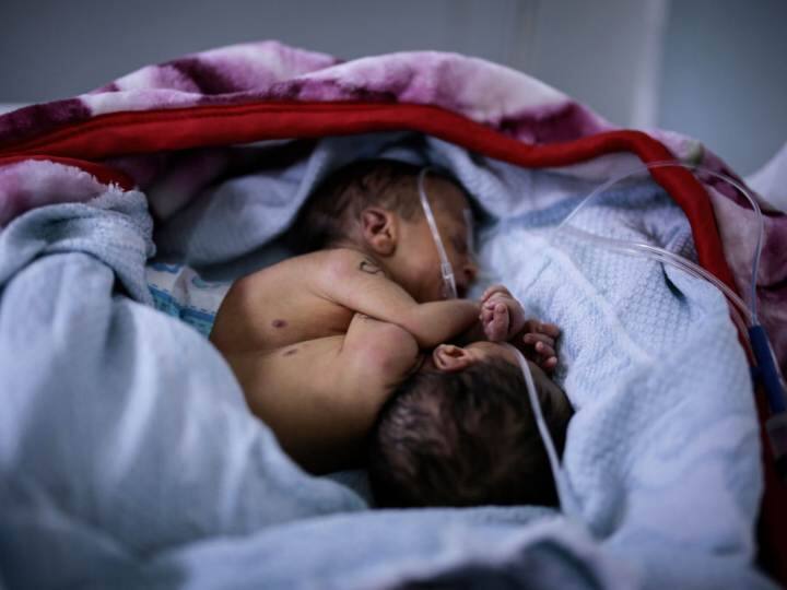 Chinese doctor found unborn twin in brain of one year old child Unborn Twin: चीन में एक साल के बच्चे के दिमाग में ऐसा मिला कुछ, डॉक्टर्स के भी उड़े होश