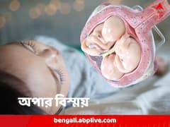 হতে পারত যমজ ভাই বা বোন, শিশুর মস্তিষ্কে ঘুমিয়ে পরজীবী ভ্রূণ