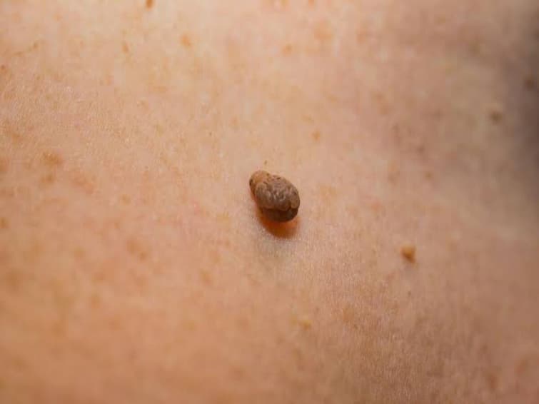 Can skin tags spread All you have to do is do this to prevent it from coming Dermatologist advice மருக்கள் பரவுமா? வராமல் இருக்க இதை செய்தால் போதும்… தோல் மருத்துவ நிபுணர் கூறும் அறிவுரை!