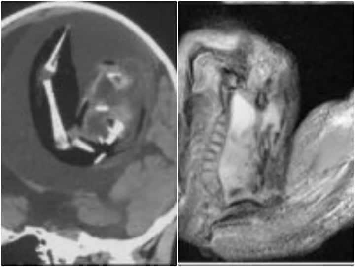 एक साल की बच्ची के दिमाग में पल रहा भ्रूण, कमर से लेकर हड्डियां तक हो गईं विकसित A fetus growing in the brain of a one-year-old girl in China एक साल की बच्ची के दिमाग में पल रहा भ्रूण, कमर से लेकर हड्डियां तक हो गईं विकसित