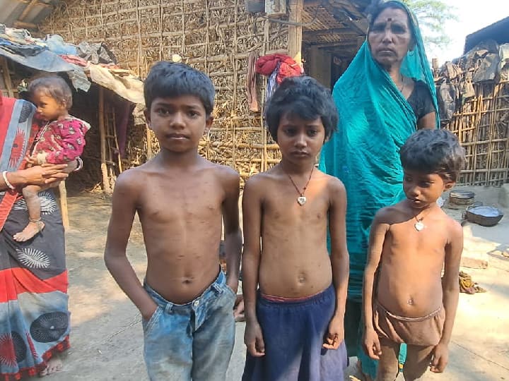 Chicken Pox Outbreak Katihar: Hundreds of people affected by chicken pox here in Bihar, seeking help from the health department ann Chicken Pox Outbreak: बिहार में यहां चिकन पॉक्स से प्रभावित हैं सैकड़ों लोग, स्वास्थ्य विभाग से लगा रहे मदद की गुहार