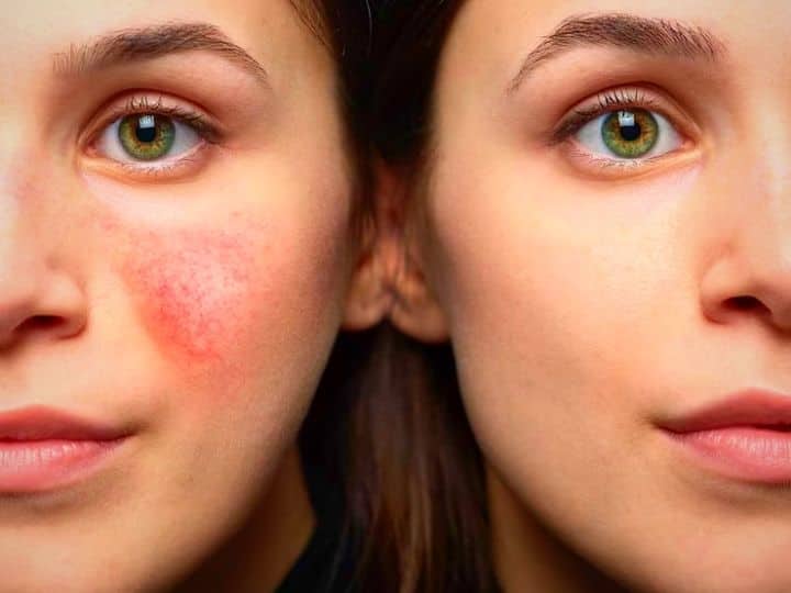 Skin Redness Home Remedy Use These Ayurveda Tips To get Rid Of Face Redness सनबर्न और एलर्जी से लाल हो जाता है चेहरा? तो तुरंत अपनाएं ये 4 घरेलू नुस्खे, छूमंतर हो जाएगी परेशानी