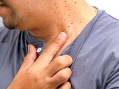 त्वचा के भद्दे मस्सों से कैसे पाएं छुटकारा? स्किन एक्सपर्ट ने बताए एक से एक इलाज